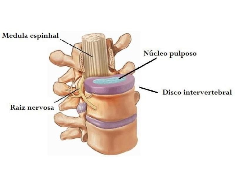 Hérnias de Disco