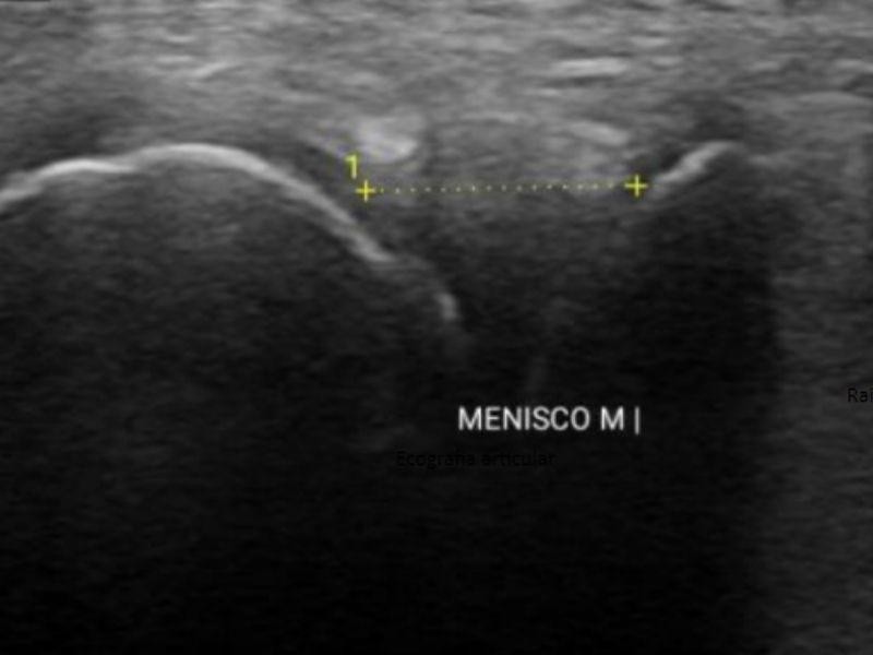 Ecografia Articular